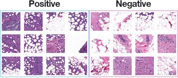Using Deep Learning for the Classification of Breast Cancer